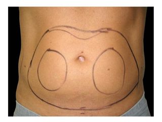 Liposcultura addome foto pre operatoria