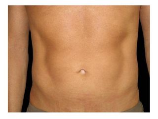 Liposcultura addome foto post operatoria