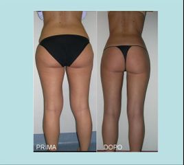 Liposcultura tridimensionale