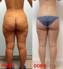 Liposcultura superficiale