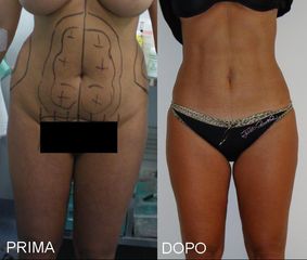 Liposcultura con miniaddominoplastica
