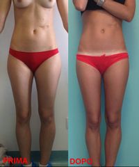 Micro-liposcultura prima e dopo