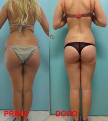 Liposcultura con simmetrizzazione