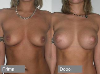 Mastoplastica additiva - Dual plane