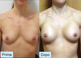 Mastoplastica additiva soft