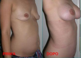 Addominoplastica & Mastoplastica Additiva