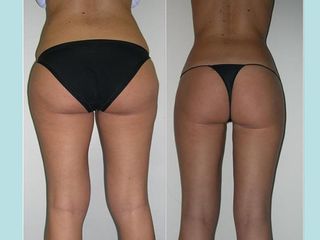 Liposuzione e liposcultura