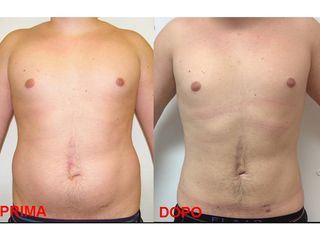 Liposuzione e liposcultura