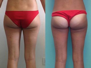 Liposizione e liposcultura