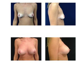 Mastoplastica additiva prima e dopo
