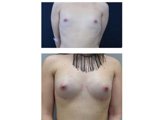 Lipofilling seno prima e dopo