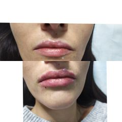 Filler labbra - Bio-Lifting Studio Medico Fronzi della Dott.ssa Stefania Fronzi