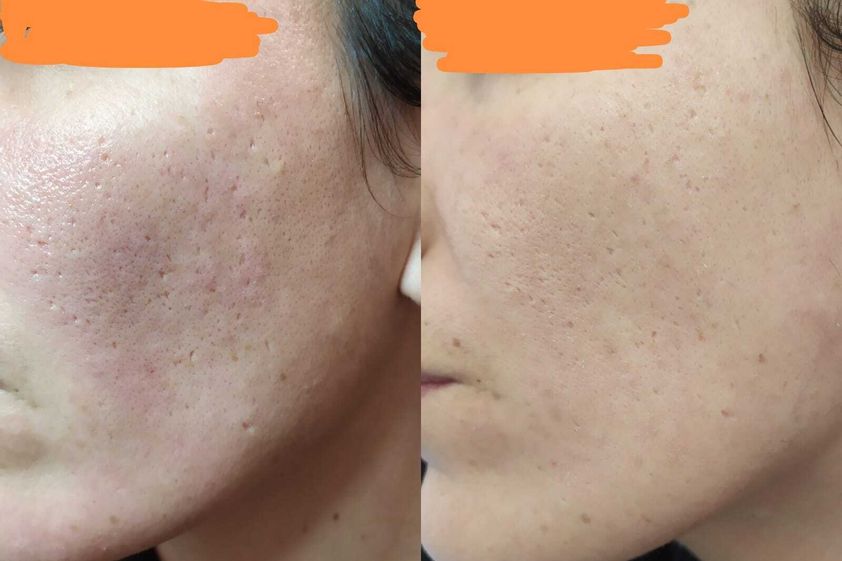 Peeling chimico prima e dopo - 841514
