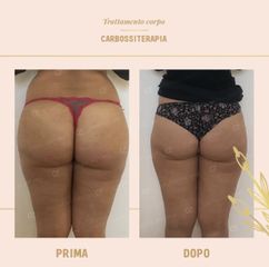 Carbossiterapia prima e dopo