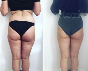 Cellulite prima e dopo