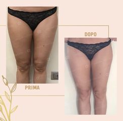 Cellulite prima e dopo
