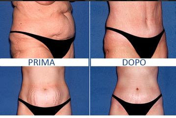 Addominoplastica prima e dopo