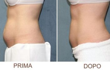Liposuzione prima e dopo