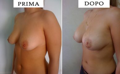 Mastoplastica riduttiva prima e dopo