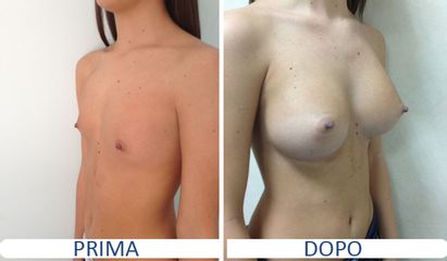 Mastoplastica additiva prima e dopo