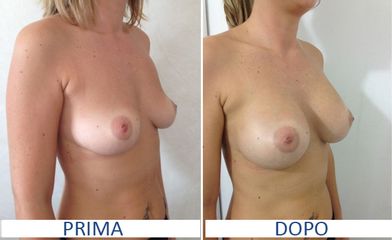 Mastoplastica additiva prima e dopo