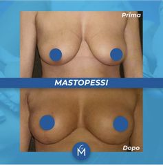 Mastopessi prima e dopo