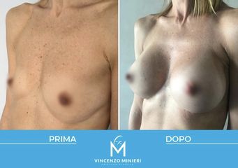 Mastoplastica additiva prima e dopo