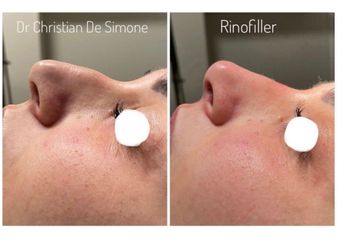 Rinofiller - Dottor Christian De Simone