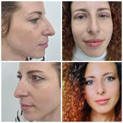 Blefaroplastica e filler labbra - Dott.ssa Angela Lazar