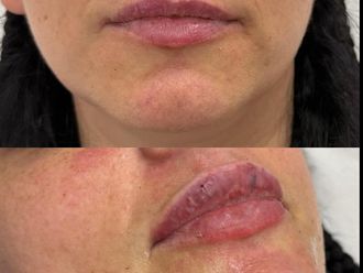Filler labbra prima e dopo - 876063