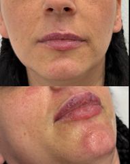 Dott.ssa Angela Lazar Filler Labbra