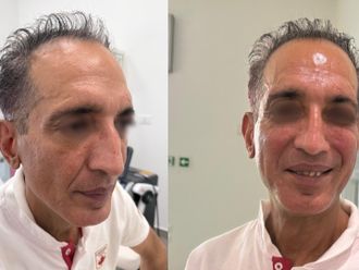 Filler prima e dopo - 876064