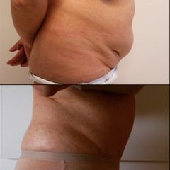 Liposuzione  - Dott. Alessandro Nube