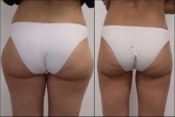 Liposuzione  - Dott. Alessandro Nube