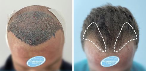 Trapianto capelli - Studio Medico Adigrat