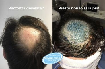 Trapianto capelli - Studio Medico Adigrat