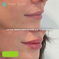 Filler labbra - Studio Medico Adigrat