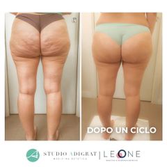 Cellulite - Studio Medico Adigrat