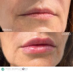 Studio Medico Adigrat Trattamento Filler labbra