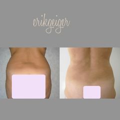 liposcultura prima dopo