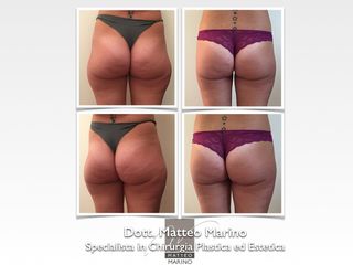 liposuzione prima dopo