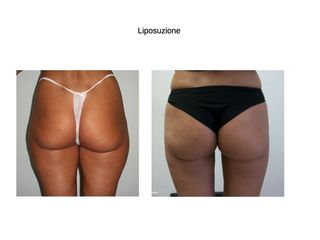 liposuzione glutei pre e post