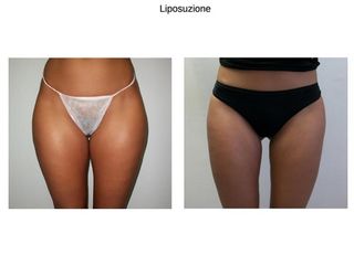 Liposuzione prima e dopo