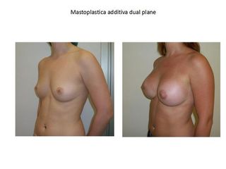 Mastoplastica additiva dual-plane
