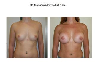 mastoplastica additiva dual plane