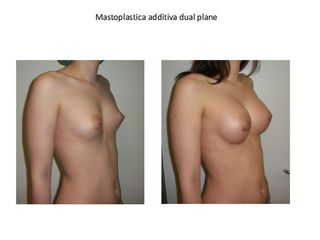 mastoplastica additiva dual plane