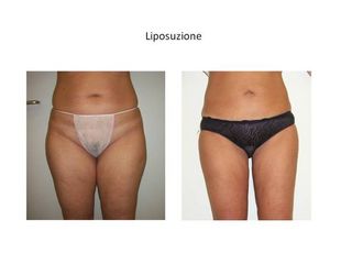 Liposuzione prima e dopo