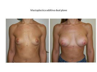 Mastoplastica additiva dual plane