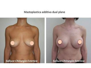 Mastoplastica prima e dopo