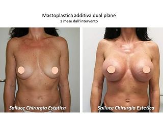 Mastoplastica prima e dopo